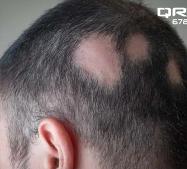 Alopecia Areata