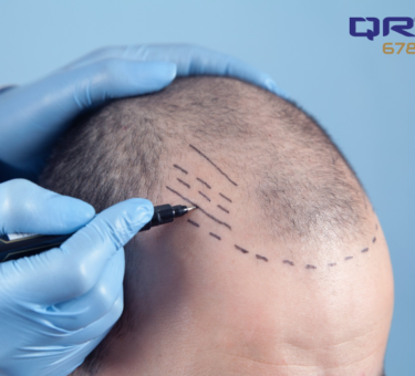 How QR678 Neo helps in the hair transplant journey.