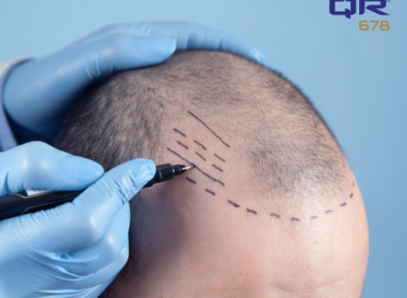 How QR678 Neo helps in the hair transplant journey.