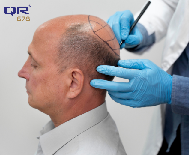 Hair Transplants – latest updates, safety, process & more