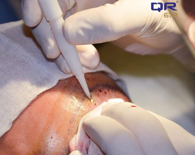 A surgeon performs Direct Hair Implantation(DHI) with an implanter pen on a patient