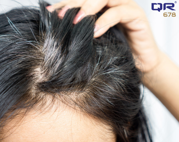 Premature Gray Hair Treatment