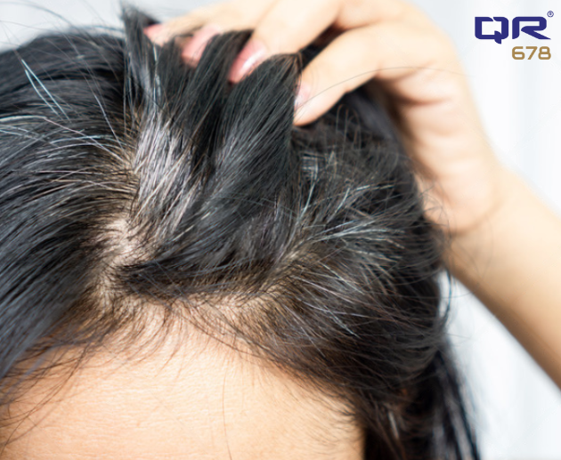 What is the Most Effective Treatment for Premature Graying Hair?