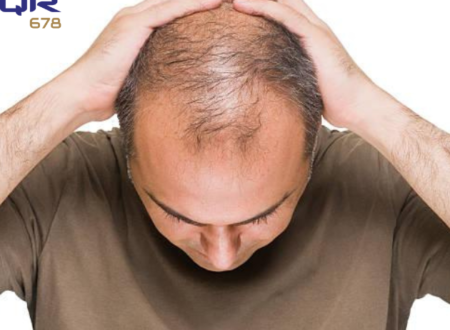 Reverse Male Pattern Baldness Naturally