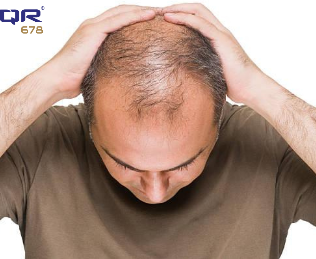 How To Reverse Male Pattern Baldness Naturally