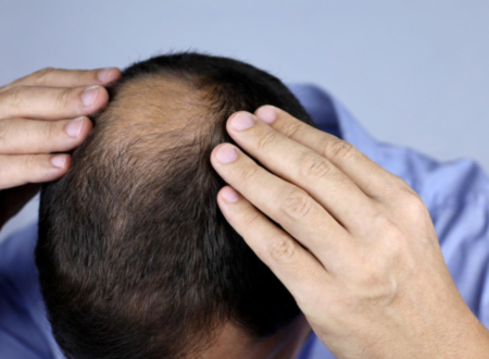 What Is Male Pattern Baldness