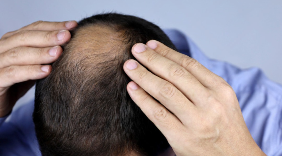 What Is Male Pattern Baldness