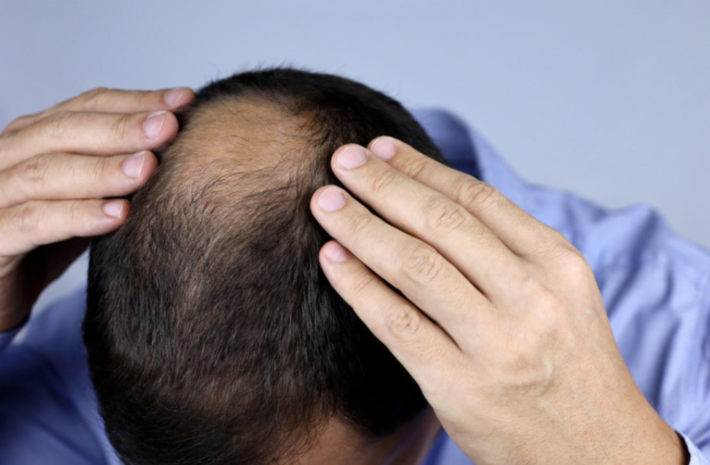 What is Male Pattern Baldness? Types, Causes, and How to Prevent It