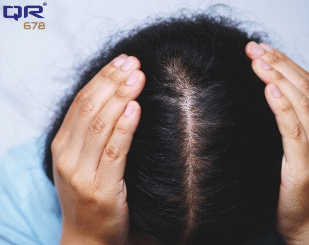Autoimmune Disease and Hair Loss